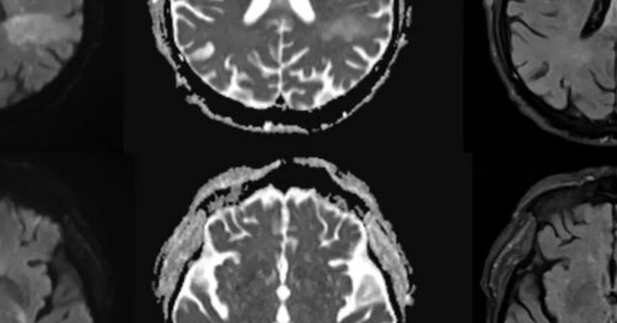 You're likely already infected with a brain-eating virus you've never heard of