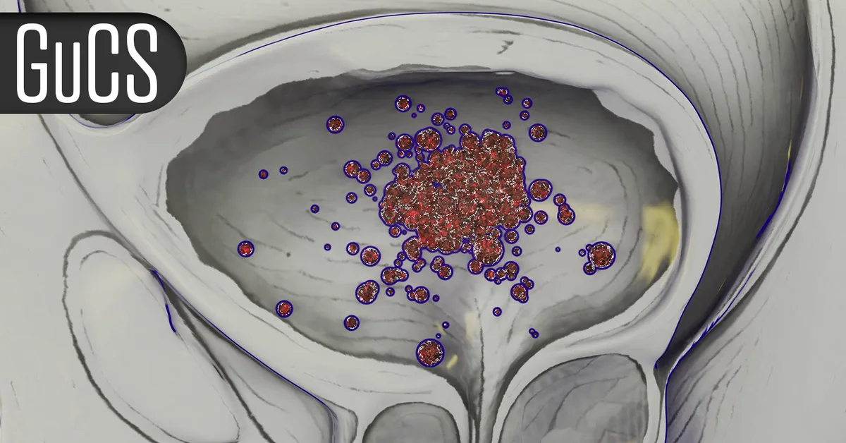 Small Study Warns on Microplastics and Prostate Tumors