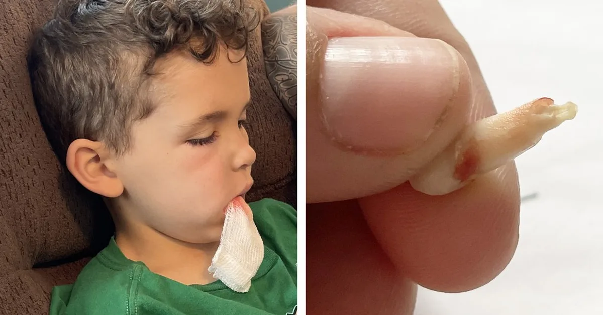 More Kids Are in ERs for Tooth Pain. Trump Cuts and RFK Jr.'s Anti-Fluoride Fight Aren't Helping.