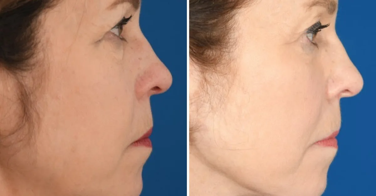 I've spent $33,000 on cosmetic procedures at 65. It's been life-changing for my career and confidence.